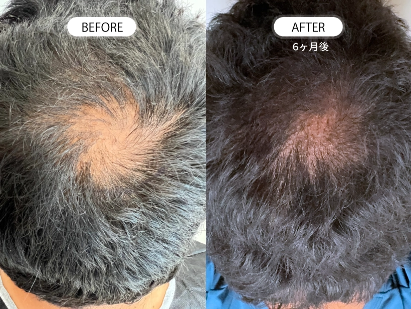 【症例】トルコ植毛