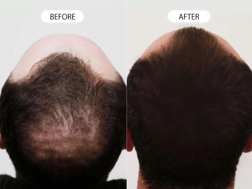 【症例】トルコ植毛