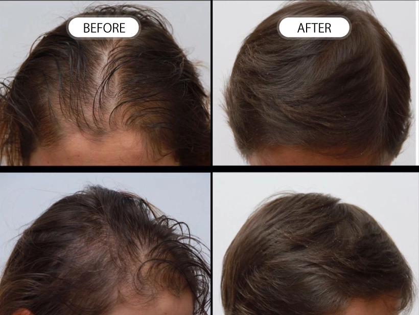 【症例】トルコ植毛