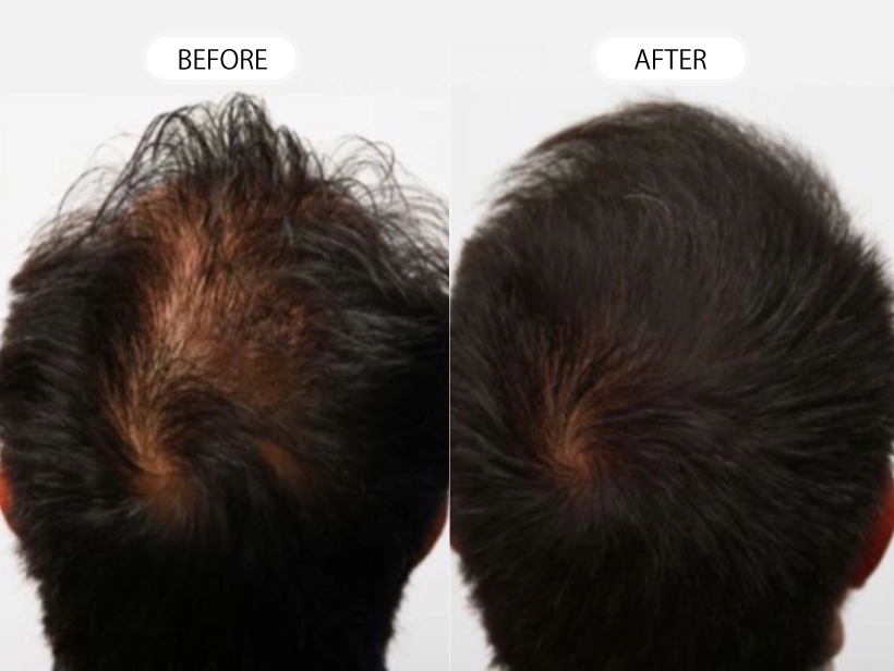 【症例】トルコ植毛